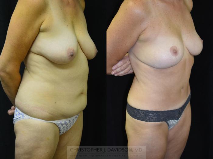 Mommy Makeover Case 401 Before & After Right Oblique | Boston, MA | Christopher J. Davidson, MD