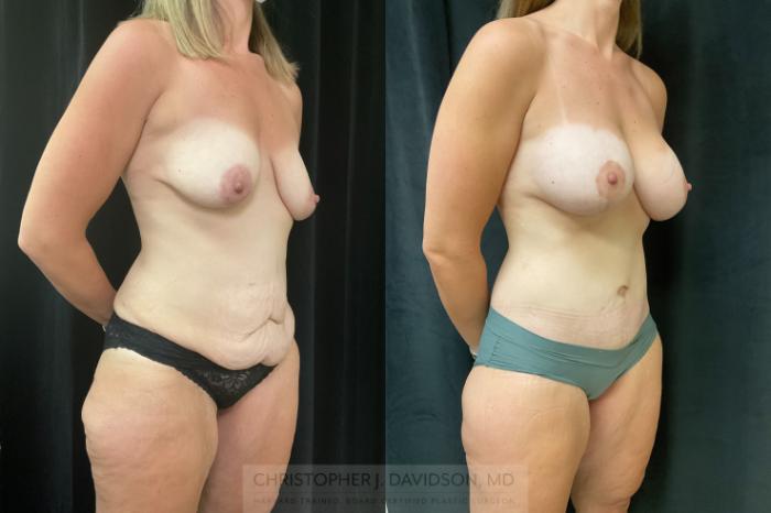 Lower Body Lift Case 424 Before & After Left Oblique | Boston, MA | Christopher J. Davidson, MD