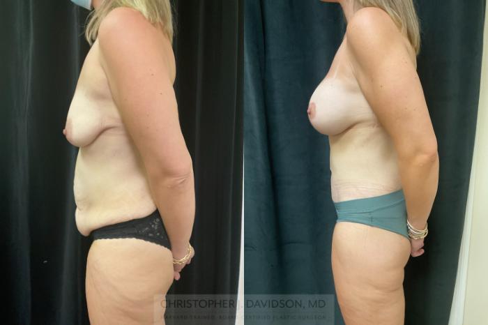 Lower Body Lift Case 424 Before & After Left Side | Boston, MA | Christopher J. Davidson, MD