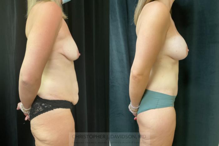 Lower Body Lift Case 424 Before & After Right Side | Boston, MA | Christopher J. Davidson, MD