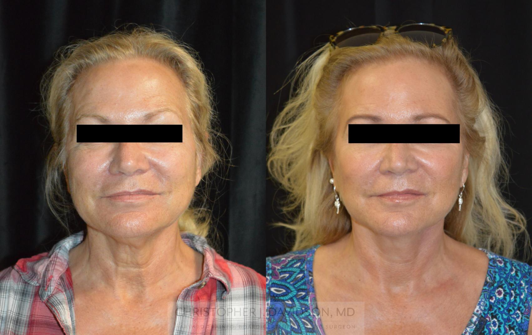 Neck Lift Case 256 Before & After Front | Boston, MA | Christopher J. Davidson, MD
