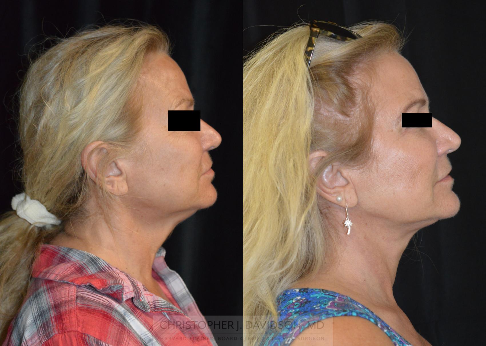 Neck Lift Case 256 Before & After Right Side | Boston, MA | Christopher J. Davidson, MD
