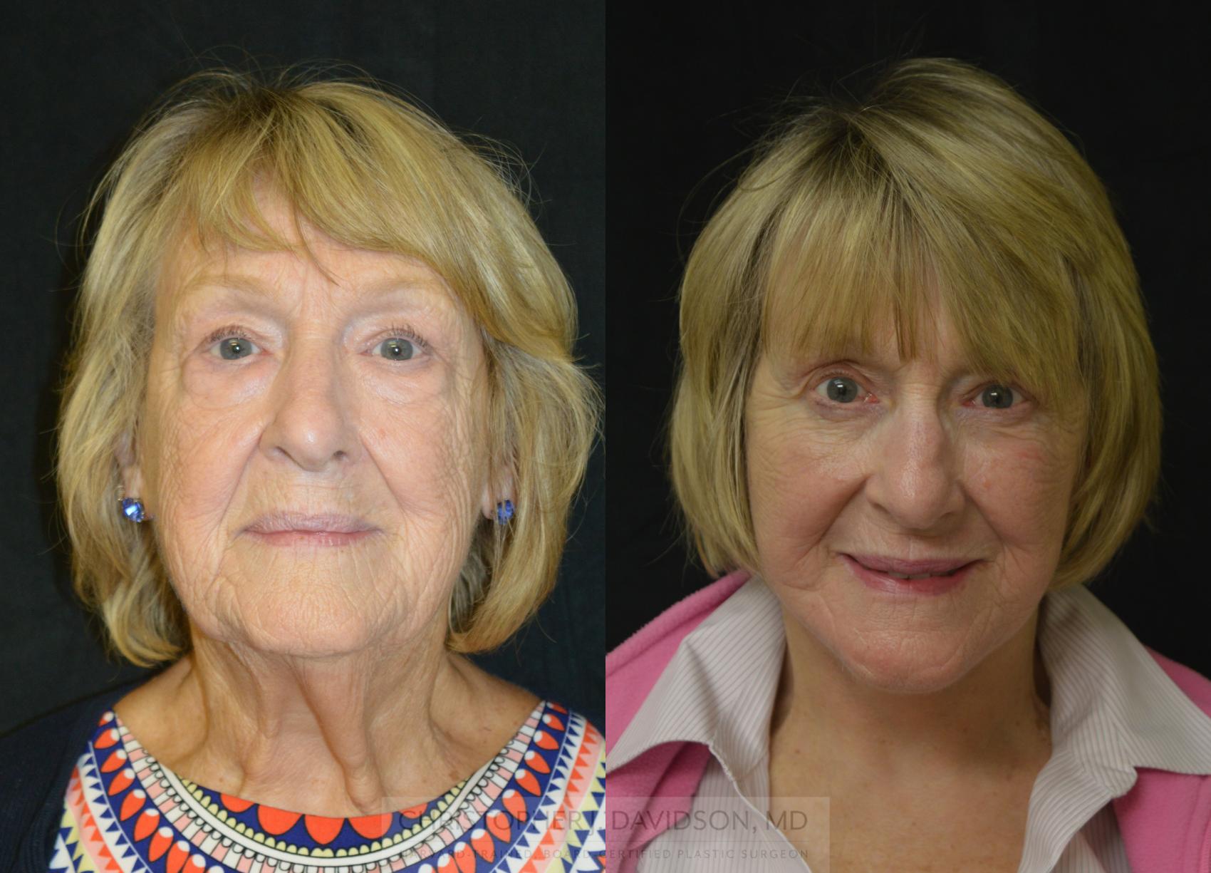 Neck Lift Case 264 Before & After Front | Boston, MA | Christopher J. Davidson, MD