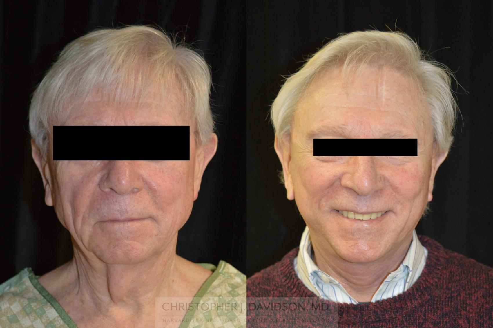 Neck Lift Case 268 Before & After Front | Boston, MA | Christopher J. Davidson, MD