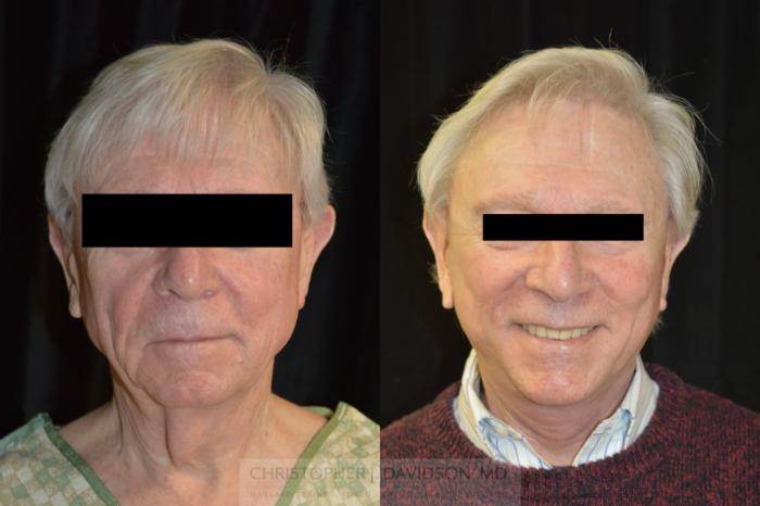 Facelift Surgery Case 268 Before & After Front | Boston, MA | Christopher J. Davidson, MD
