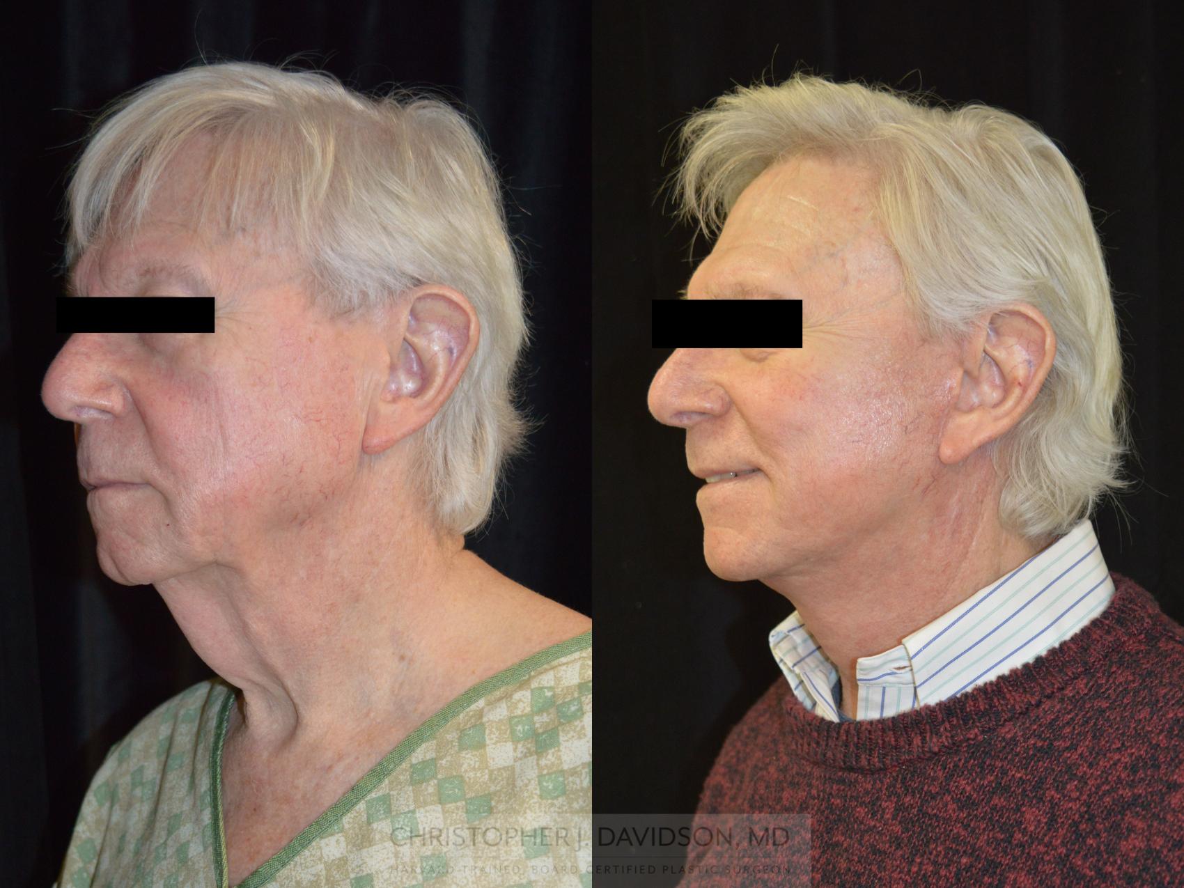 Facelift Surgery Case 268 Before & After Left Oblique | Wellesley, MA | Christopher J. Davidson, MD