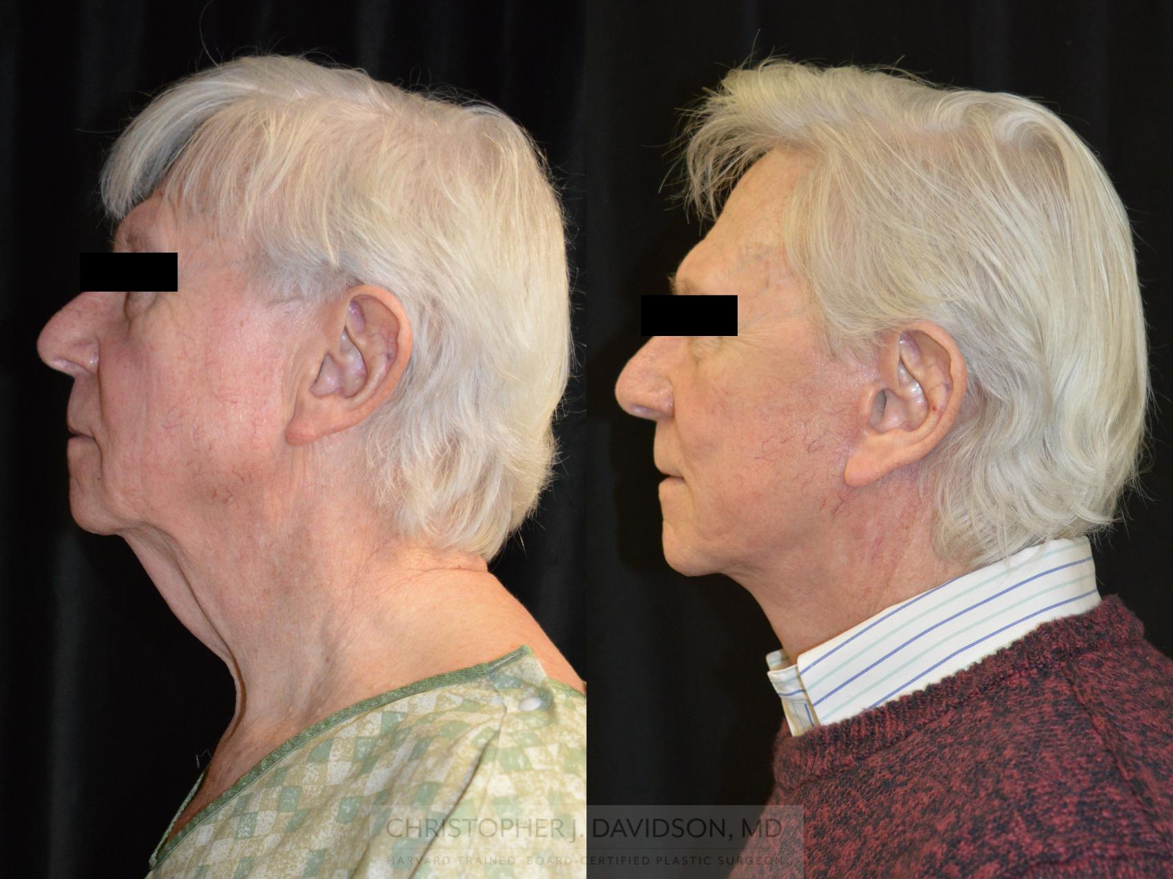Facelift Surgery Case 268 Before & After Left Side | Wellesley, MA | Christopher J. Davidson, MD