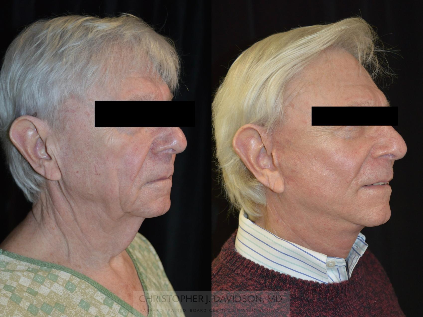 Facelift Surgery Case 268 Before & After Right Oblique | Wellesley, MA | Christopher J. Davidson, MD