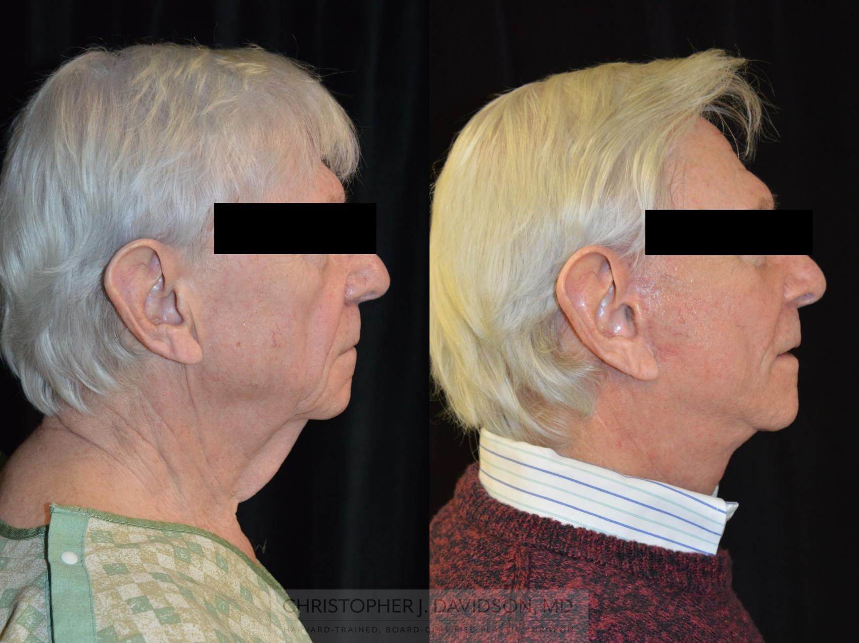 Facelift Surgery Case 268 Before & After Right Side | Wellesley, MA | Christopher J. Davidson, MD