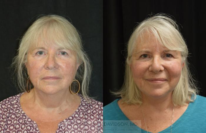 Neck Lift Case 288 Before & After Front | Boston, MA | Christopher J. Davidson, MD