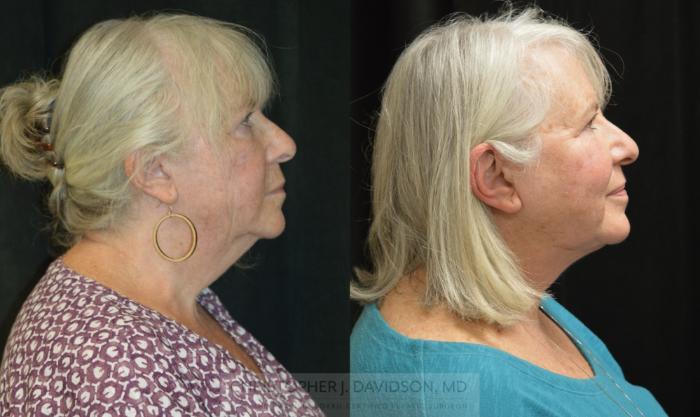 Neck Lift Case 288 Before & After Right Side | Boston, MA | Christopher J. Davidson, MD