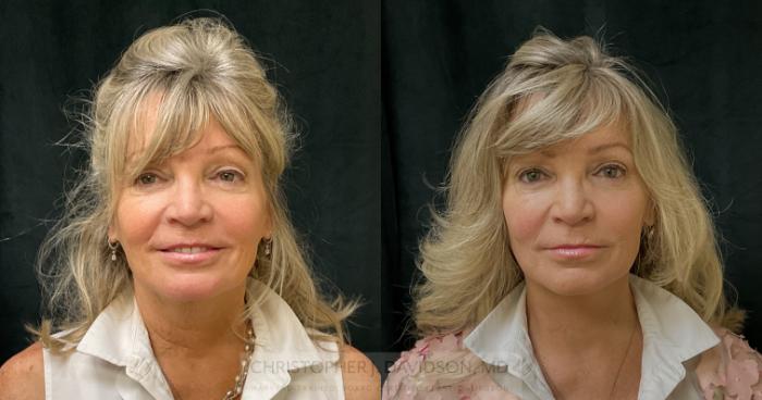 Neck Lift Case 306 Before & After Front | Boston, MA | Christopher J. Davidson, MD