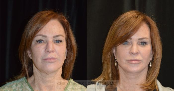 Neck Lift Case 314 Before & After Front | Boston, MA | Christopher J. Davidson, MD