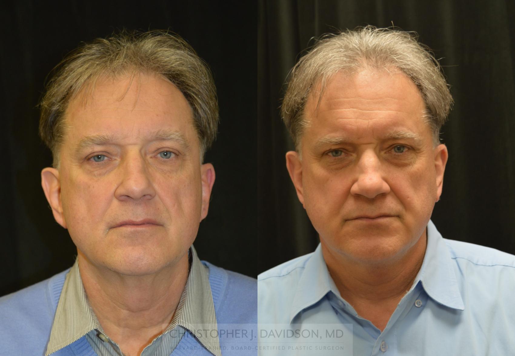 Neck Lift Case 322 Before & After Front | Boston, MA | Christopher J. Davidson, MD