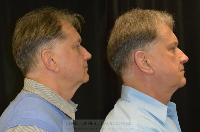Neck Lift Case 322 Before & After Right Side | Boston, MA | Christopher J. Davidson, MD