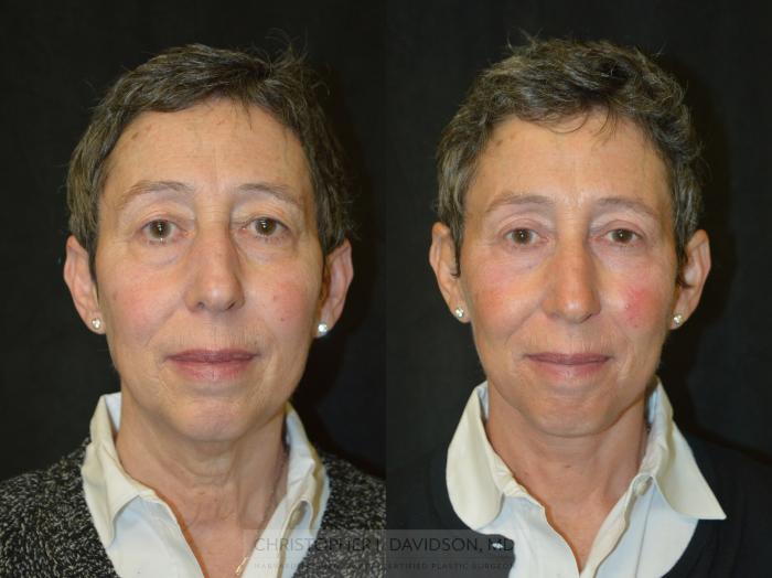 Neck Lift Case 332 Before & After Front | Boston, MA | Christopher J. Davidson, MD