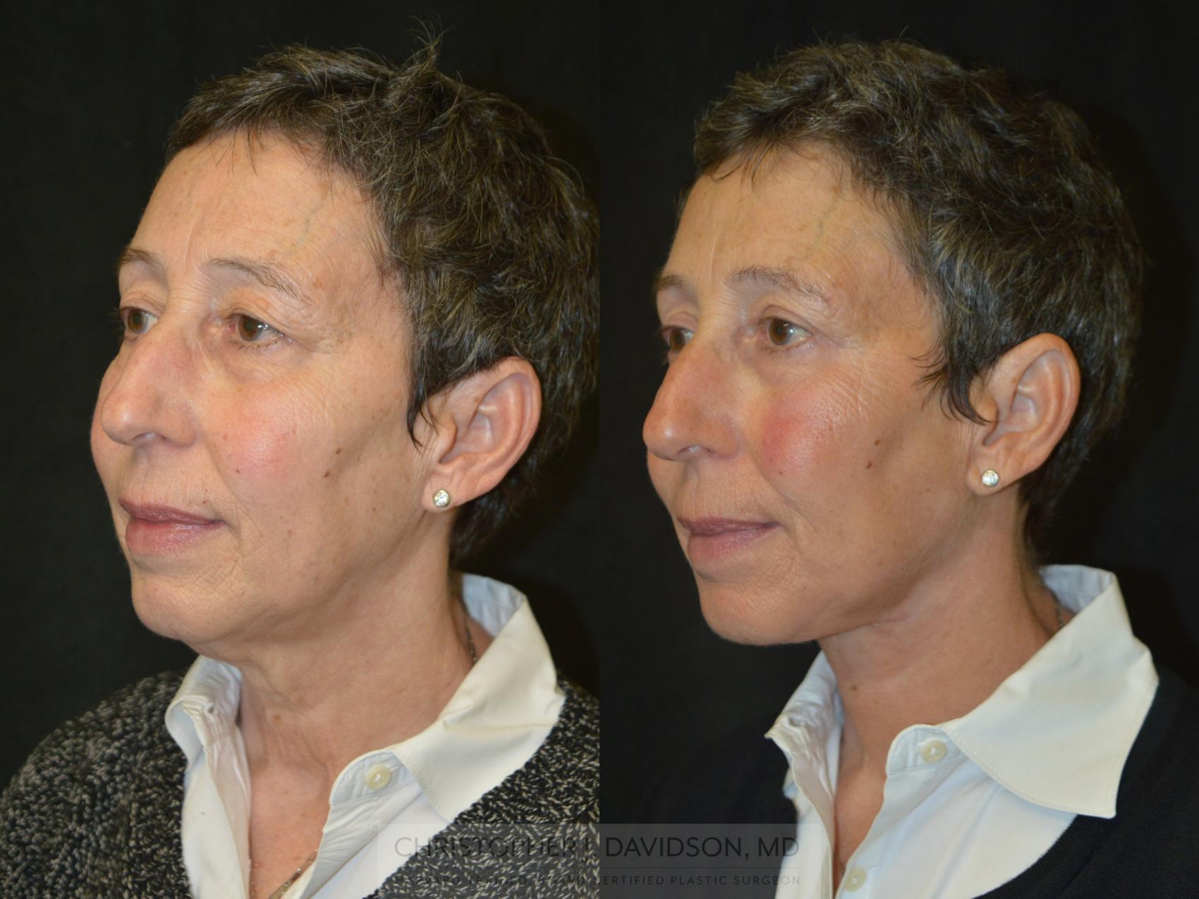 Neck Lift Before and After Pictures Case 332 Boston, MA Christopher