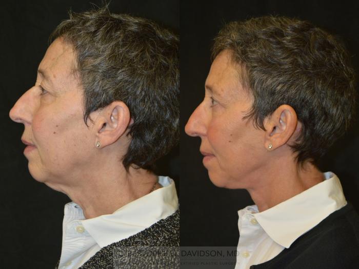 Facelift Surgery Case 332 Before & After Left Side | Boston, MA | Christopher J. Davidson, MD