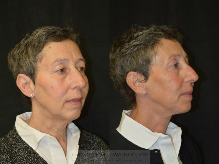 Facelift Surgery Case 332 Before & After Right Oblique | Boston, MA | Christopher J. Davidson, MD