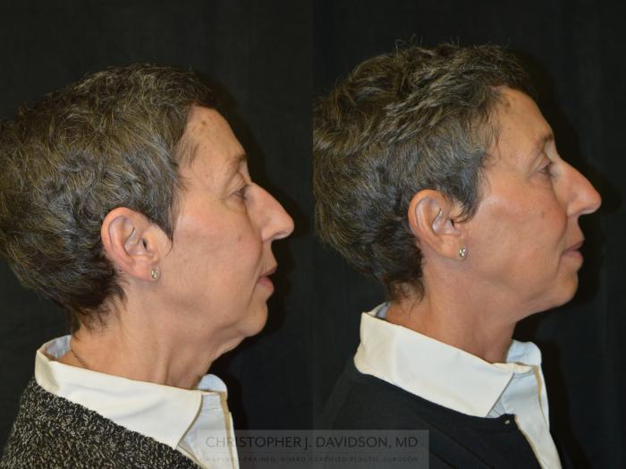 Facelift Surgery Case 332 Before & After Right Side | Boston, MA | Christopher J. Davidson, MD