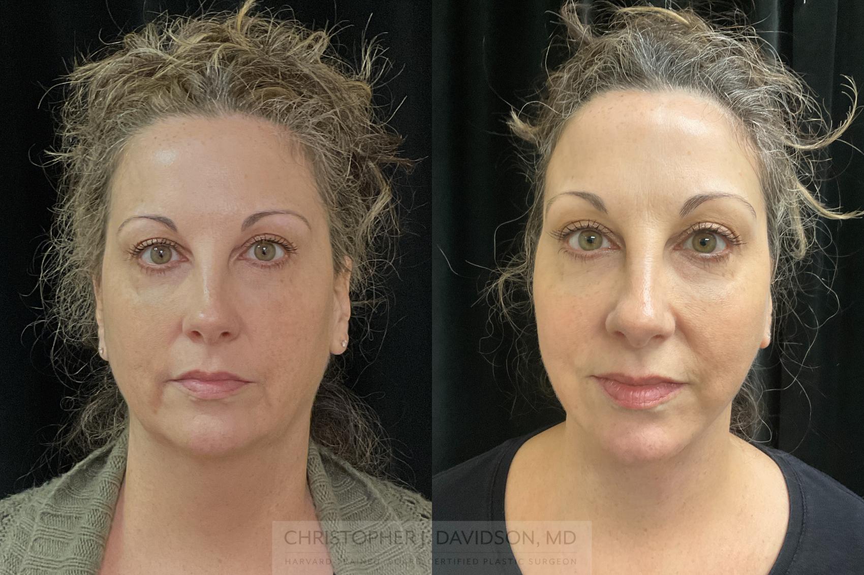 Neck Lift Case 359 Before & After Front | Boston, MA | Christopher J. Davidson, MD