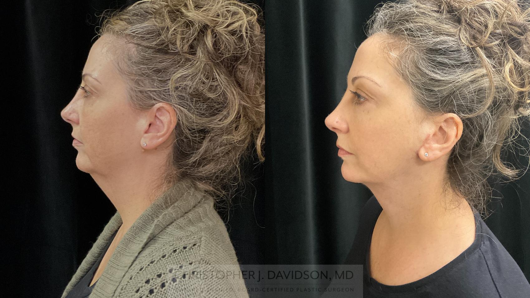 Neck Lift Before and After Pictures Case 359 | Boston, MA | Christopher ...