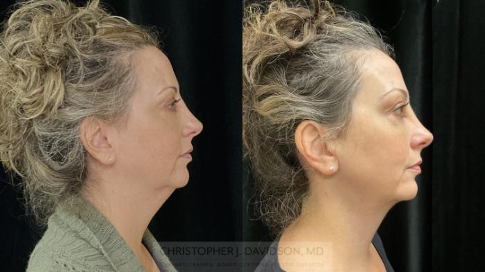 Neck Lift Case 359 Before & After Right Side | Boston, MA | Christopher J. Davidson, MD