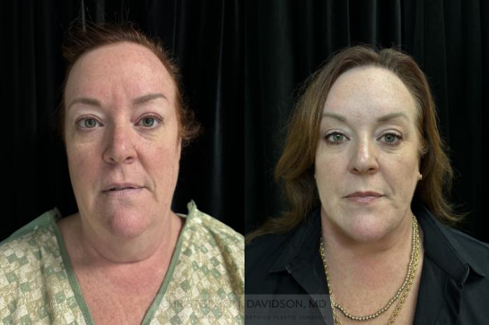 Neck Lift Case 414 Before & After Front | Boston, MA | Christopher J. Davidson, MD