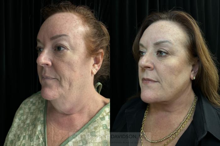 Neck Lift Case 414 Before & After Left Oblique | Boston, MA | Christopher J. Davidson, MD