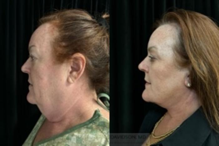 Neck Lift Case 414 Before & After Left Side | Boston, MA | Christopher J. Davidson, MD