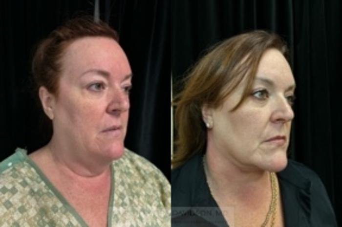 Neck Lift Case 414 Before & After Right Oblique | Boston, MA | Christopher J. Davidson, MD