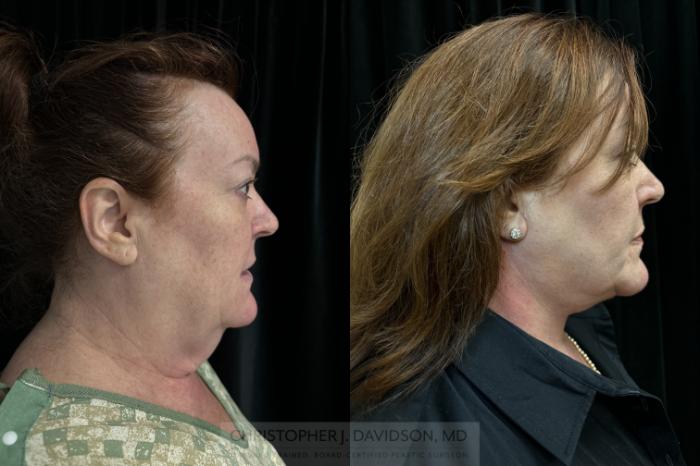 Neck Lift Case 414 Before & After Right Side | Boston, MA | Christopher J. Davidson, MD