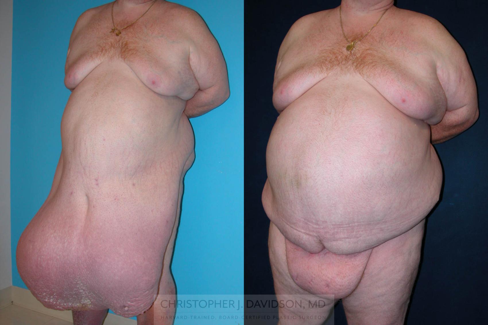 Panniculectomy Case 206 Before & After View #2 | Wellesley, MA | Christopher J. Davidson, MD