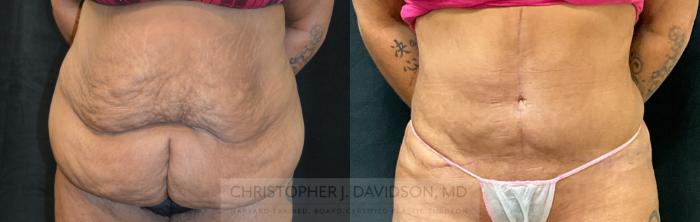 Tummy Tuck (Abdominoplasty) Case 298 Before & After Front | Boston, MA | Christopher J. Davidson, MD