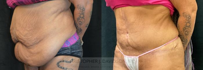 Tummy Tuck (Abdominoplasty) Case 298 Before & After Left Oblique | Boston, MA | Christopher J. Davidson, MD