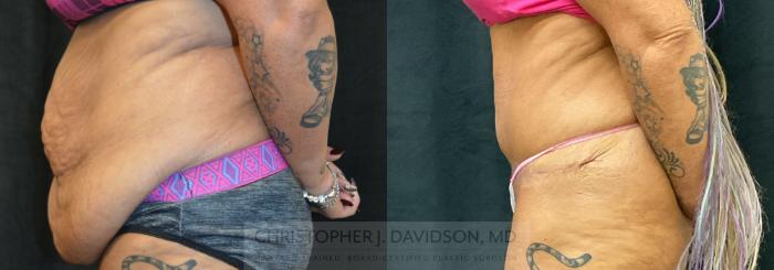 Liposuction Case 298 Before & After Left Side | Boston, MA | Christopher J. Davidson, MD