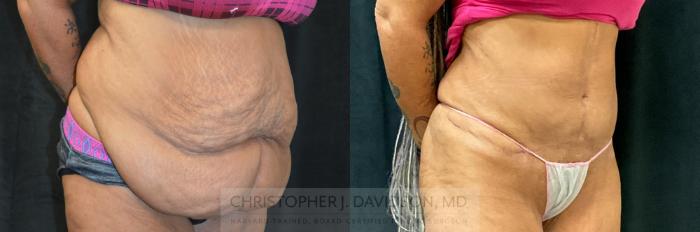 Tummy Tuck (Abdominoplasty) Case 298 Before & After Right Oblique | Boston, MA | Christopher J. Davidson, MD