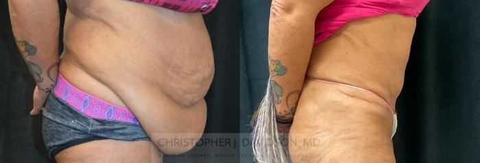 Liposuction Case 298 Before & After Right Side | Boston, MA | Christopher J. Davidson, MD