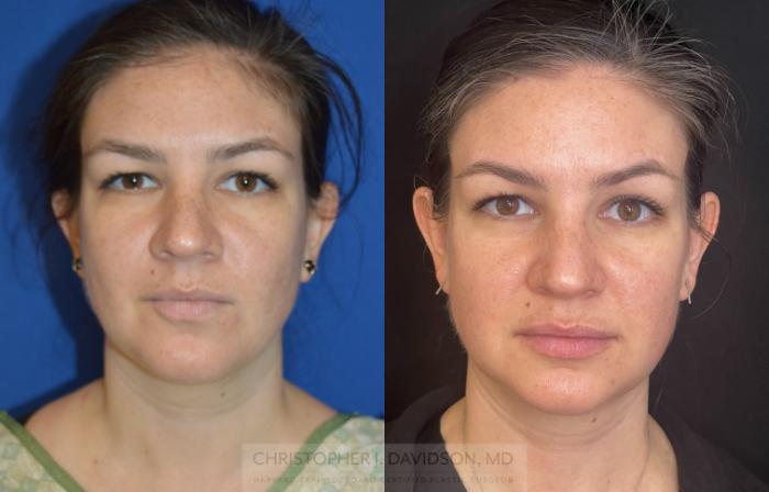 Submental Liposuction Case 272 Before & After Front | Boston, MA | Christopher J. Davidson, MD