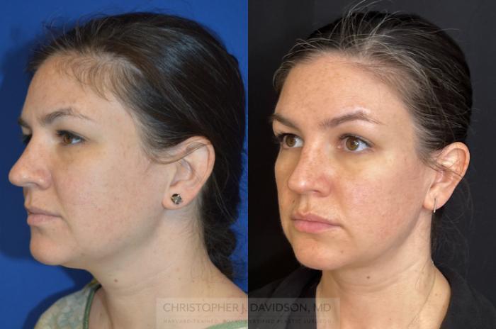 Submental Liposuction Case 272 Before & After Left Oblique | Boston, MA | Christopher J. Davidson, MD