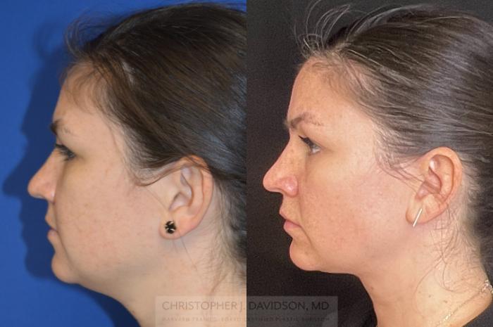 Submental Liposuction Case 272 Before & After Left Side | Boston, MA | Christopher J. Davidson, MD
