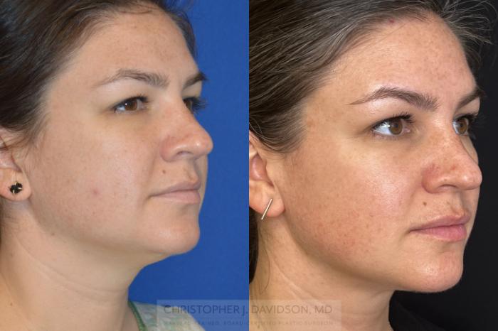 Submental Liposuction Case 272 Before & After Right Oblique | Boston, MA | Christopher J. Davidson, MD