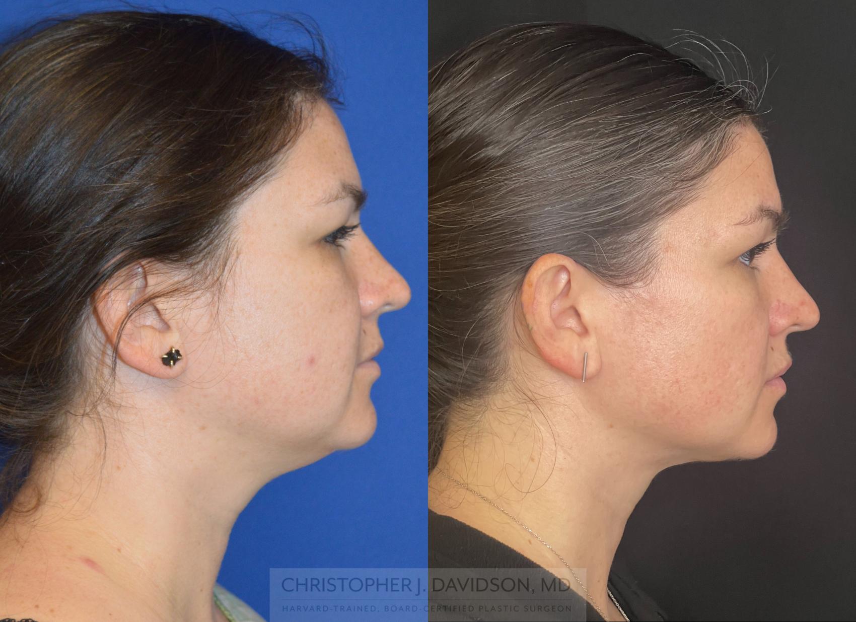 Submental Liposuction Case 272 Before & After Right Side | Boston, MA | Christopher J. Davidson, MD