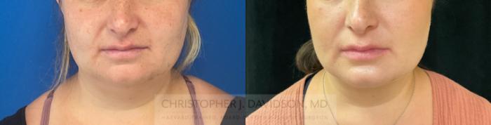 Submental Liposuction Case 281 Before & After Front | Boston, MA | Christopher J. Davidson, MD