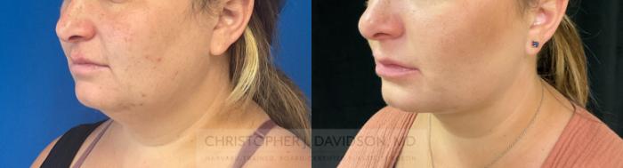 Submental Liposuction Case 281 Before & After Left Oblique | Boston, MA | Christopher J. Davidson, MD