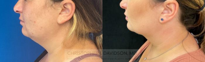 Submental Liposuction Case 281 Before & After Left Side | Boston, MA | Christopher J. Davidson, MD