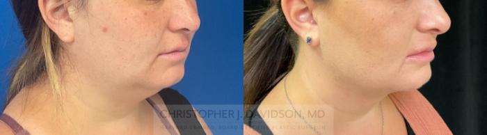 Submental Liposuction Case 281 Before & After Right Oblique | Boston, MA | Christopher J. Davidson, MD