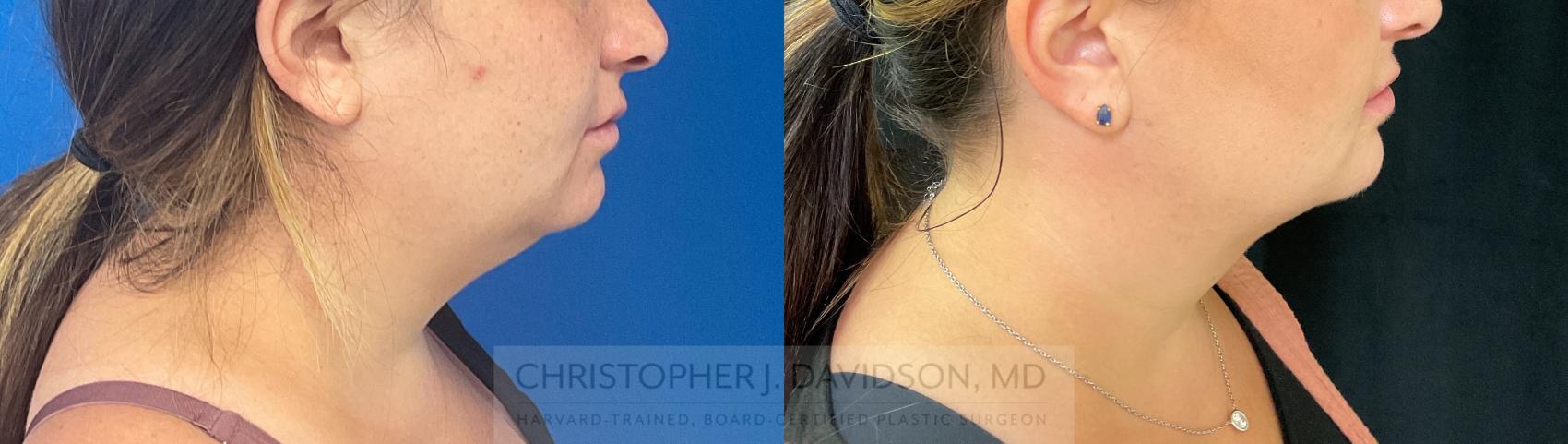Submental Liposuction Case 281 Before & After Right Side | Boston, MA | Christopher J. Davidson, MD