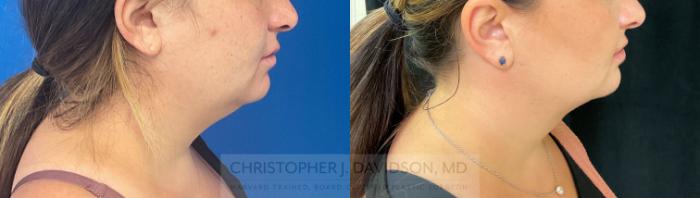Submental Liposuction Case 281 Before & After Right Side | Boston, MA | Christopher J. Davidson, MD