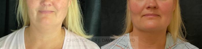 Submental Liposuction Case 301 Before & After Front | Boston, MA | Christopher J. Davidson, MD